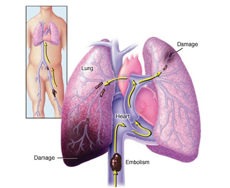 Biomedgrid | Severe Pulmonary Embolism, Research